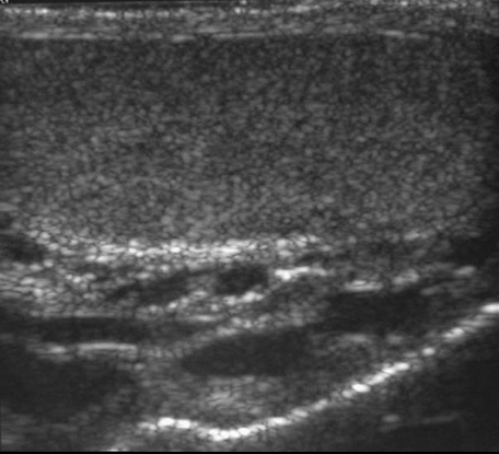 Varicocoele Ultrasound
